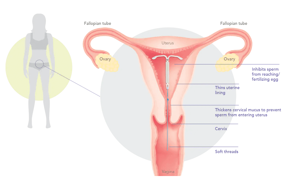 Diagram showing how Kyleena® (levonorgestrel-releasing intrauterine system) 19.5 mg IUD works in the uterus.